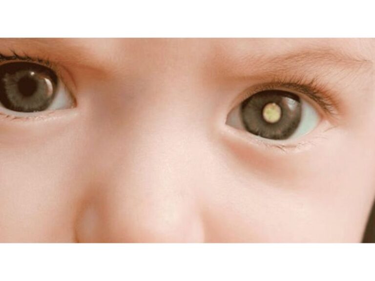 Retinoblastoma em Crianças